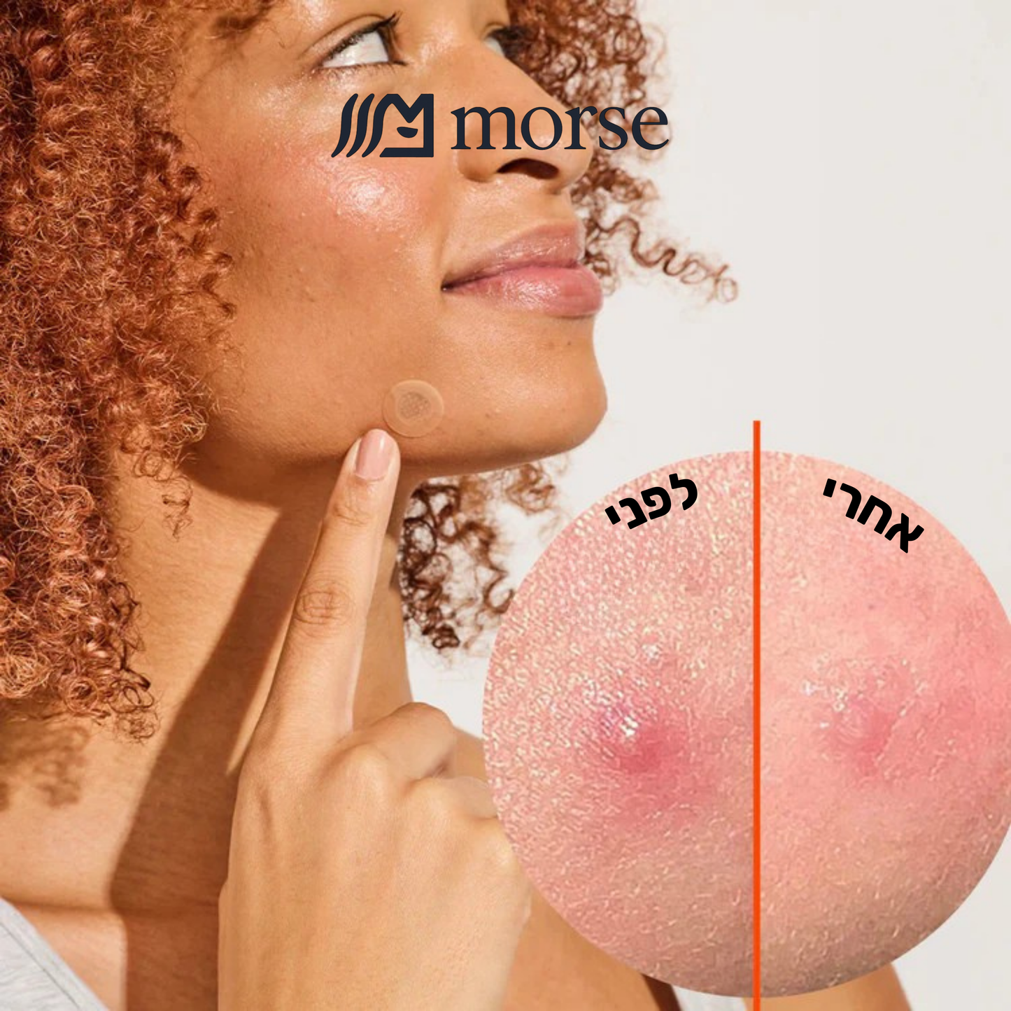 מדבקות מיקרודארט חדשניות שמטפלות בפצעי אקנה כבר מהשלב הראשון