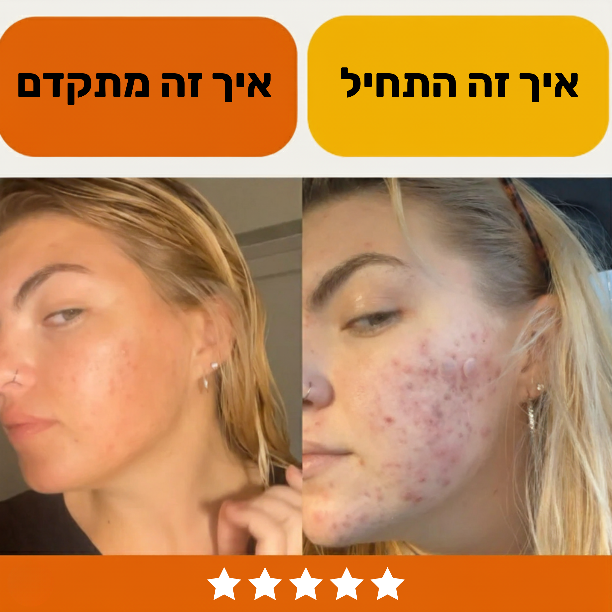 שלישיית הטבע – מערכת מלאה נגד אקנה