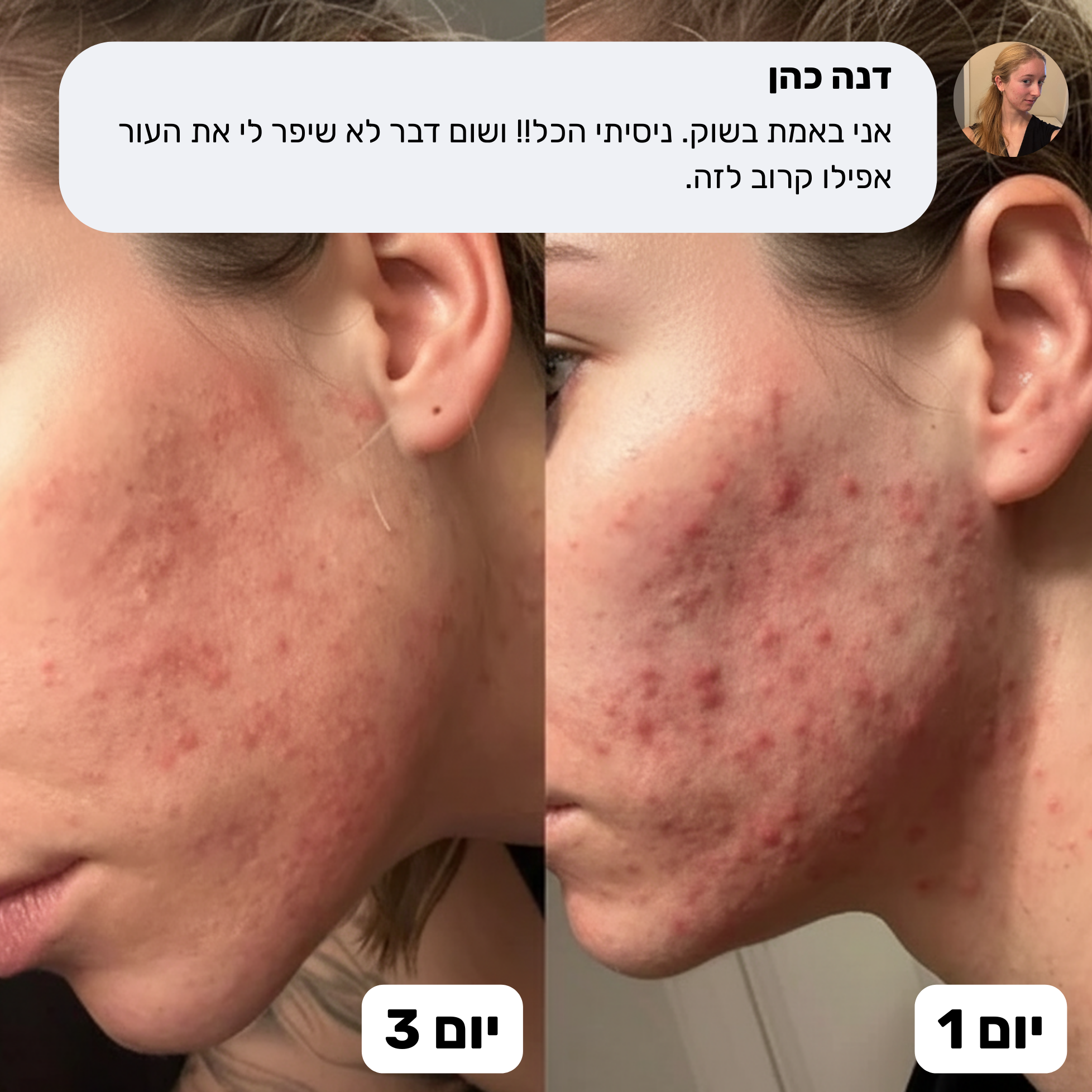 שלישיית הטבע – מערכת מלאה נגד אקנה