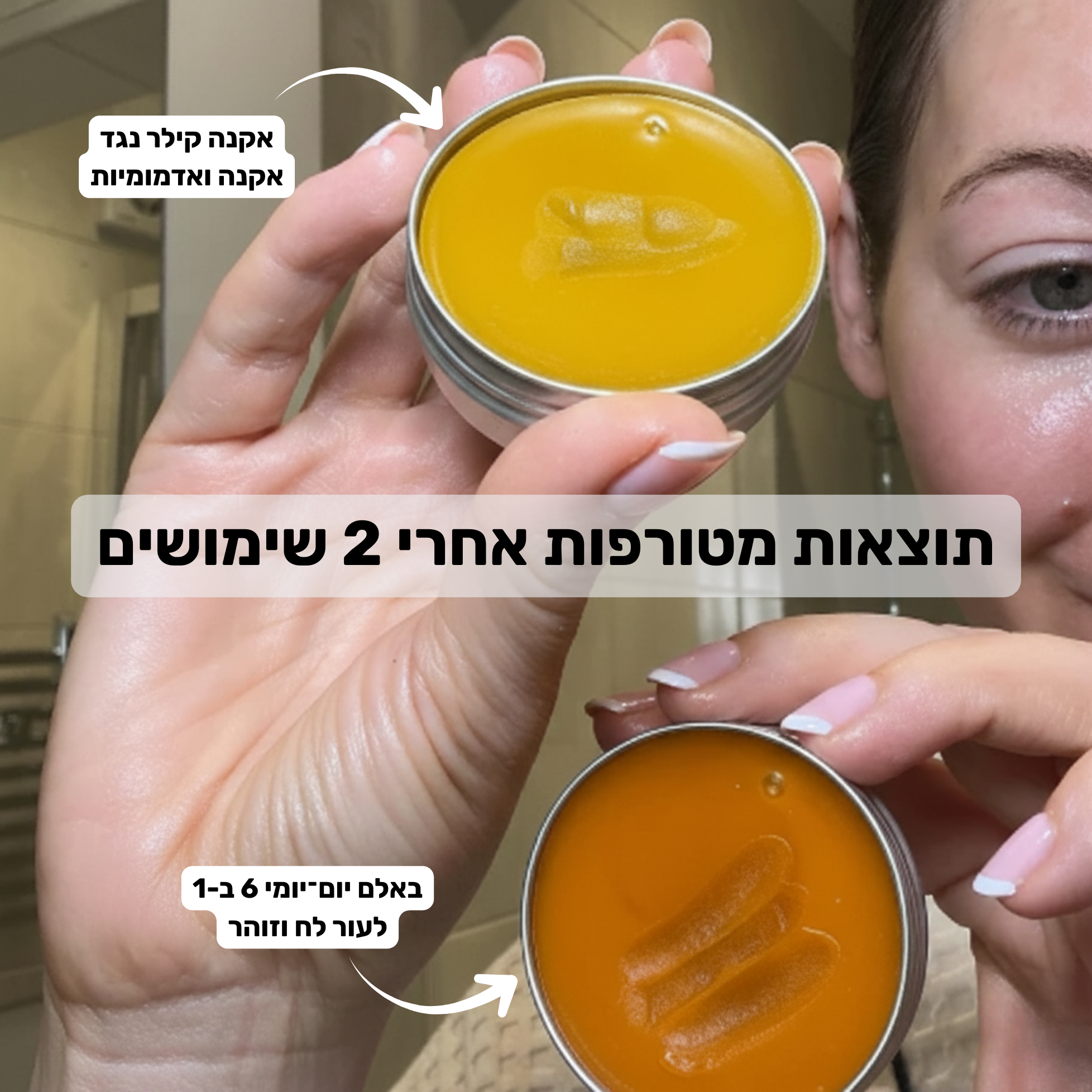 שלישיית הטבע – מערכת מלאה נגד אקנה
